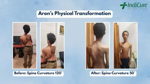 Aron's physical transformation before and after his scoliosis surgery. The left side shows his spine curvature at 120 degrees, and the right side shows his spine corrected to 50 degrees after surgery
